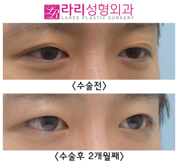 [Rari Plastic Surgery] Before-and-After Photos of Surgery to Remove a Folded Double Eyelid After Incisional Double Eyelid Surgery image 1