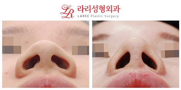 [Lari Plastic Surgery] Nose Surgery / Alar Reduction 4-Year Long-Term Follow-Up Before-and-After Photos image 1