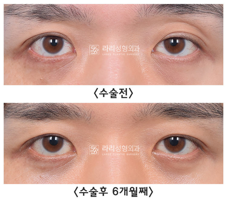 [라리성형외과] 아이홀 꺼짐 있는 눈 파악하고, 윗눈꺼풀 지방이식으로 교정 관련 이미지 12