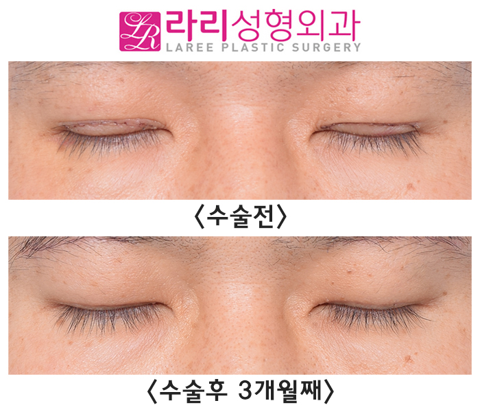 [라리성형외과] 절개 눈매교정 후 급속교정, 6개월 기다리지 않고 일주일 만에 쌍꺼풀없애기 관련 이미지 7