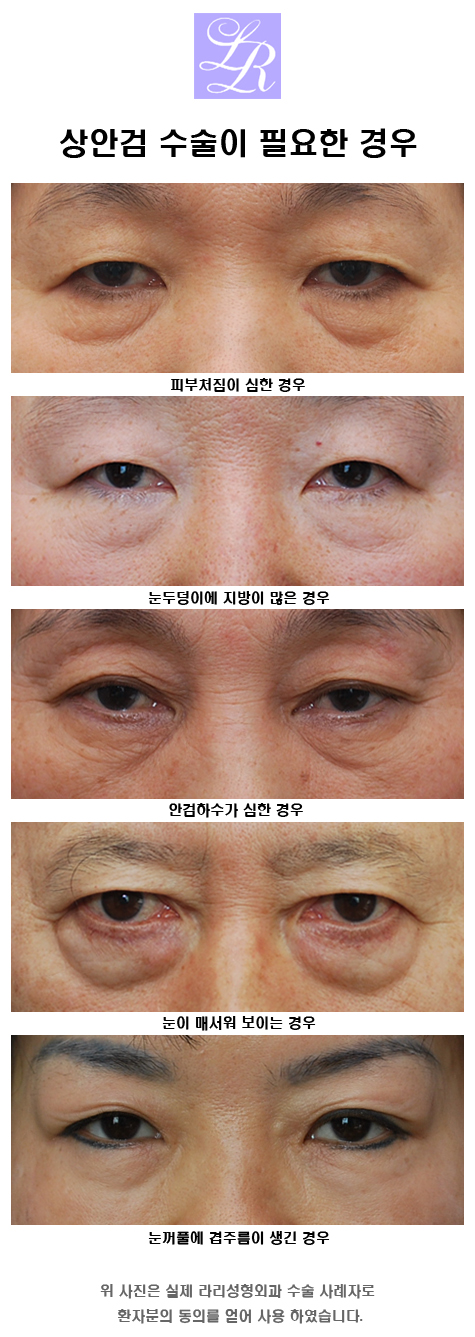 Upper Blepharoplasty and Lower Blepharoplasty image 1