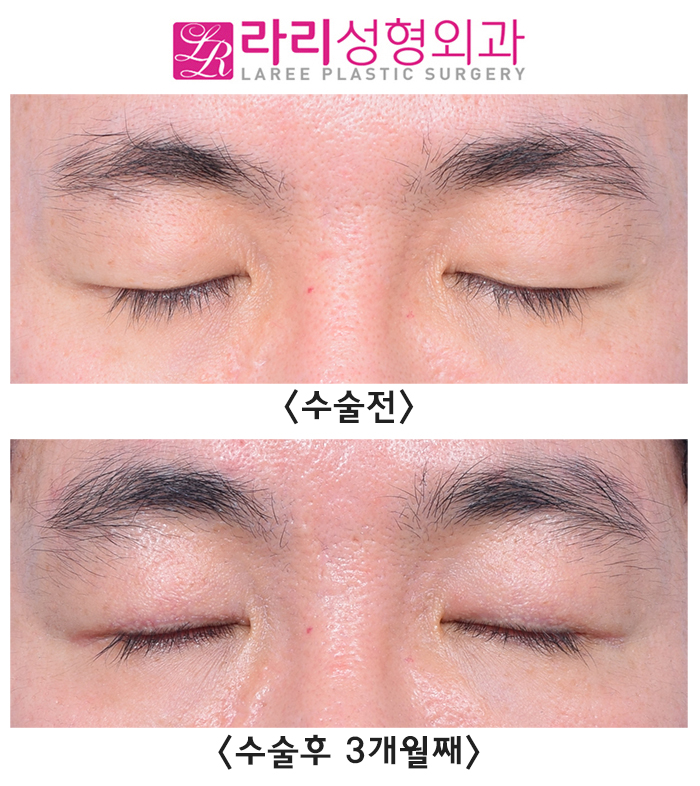[라리성형외과] 함께해서 더 효과적인 상안검수술과 눈썹거상수술 전후 사진 관련 이미지 4