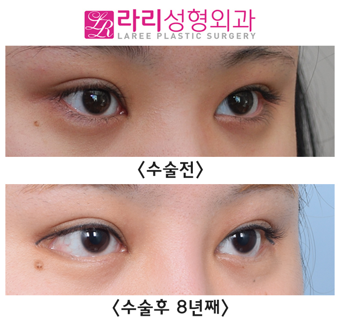 [라리성형외과] 단기 경과에 이은 뒤트임수술 8년 장기 경과 수술 전후 사진 관련 이미지 3