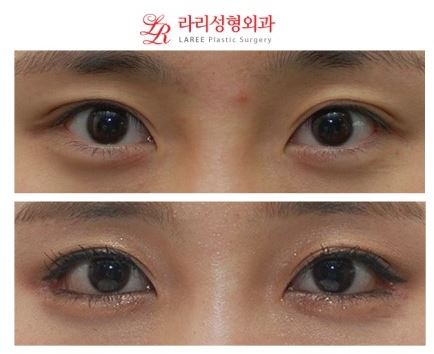 Lateral Canthoplasty / Outer Corner Canthoplasty / Outer Eye Corner Lowering Canthoplasty Before and After Photos image 4