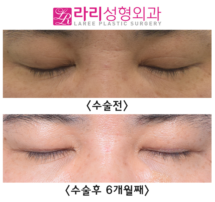 [Rari Plastic Surgery] Before and After Surgery to Remove Uneven Natural Double Eyelids Accompanied by Sagging Skin image 5