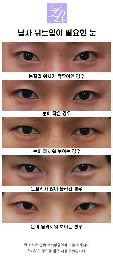 Male Epicanthoplasty - Can It Be Done Together with Canthoplasty? image 4