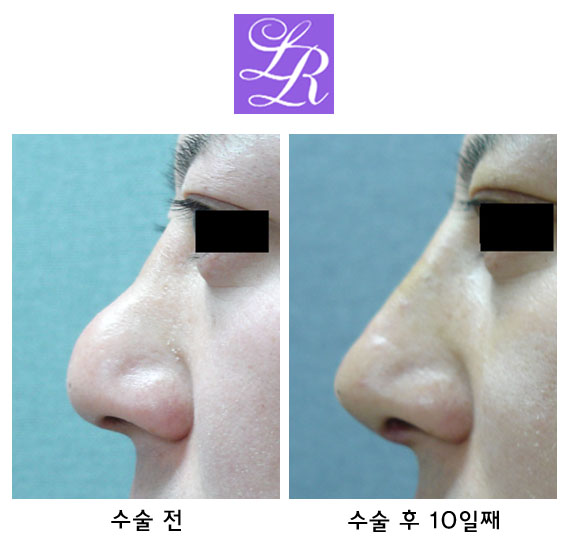 휘어진코? 휜코? 매부리코? 메부리코? 교정 관련 이미지 7