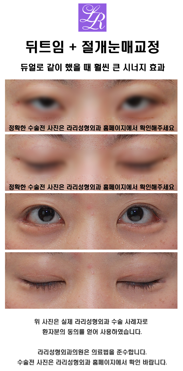 뒤트임 눈매교정 함께 관련 이미지 5
