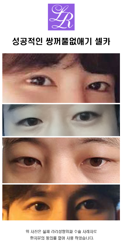 Double Eyelid Removal Surgery: Delicate Dissection Is Important! image 3
