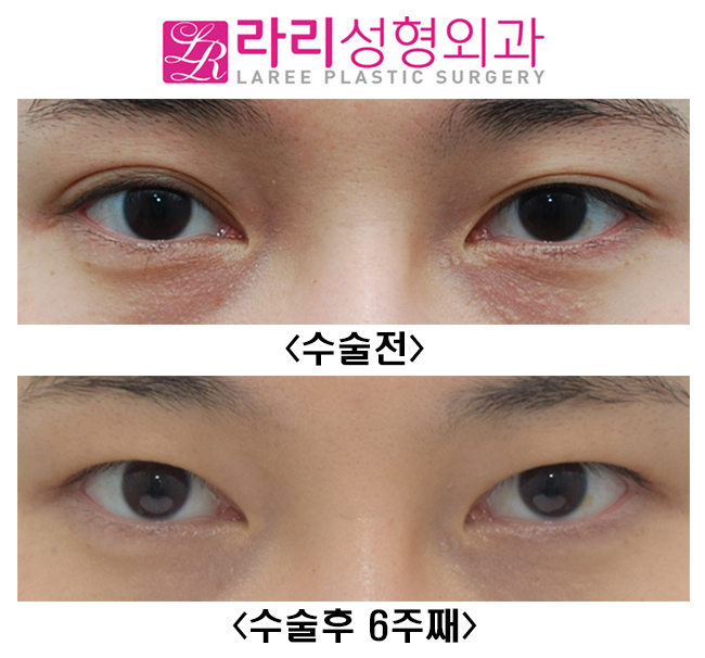 [Lari Plastic Surgery] Short-term progress after surgery to remove a natural double eyelid and make it monolid image 1