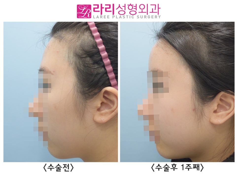 [Rari Plastic Surgery] Facial Fat Grafting (Forehead, Cheeks) Before-and-After Photos: 1-Week Progress image 5