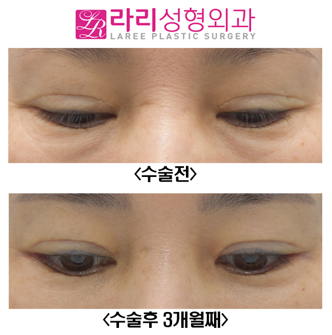 [Lari Plastic Surgery] Before-and-After Photos of Correcting Sausage-like Double Eyelids with Revision Double Eyelid Surgery image 4