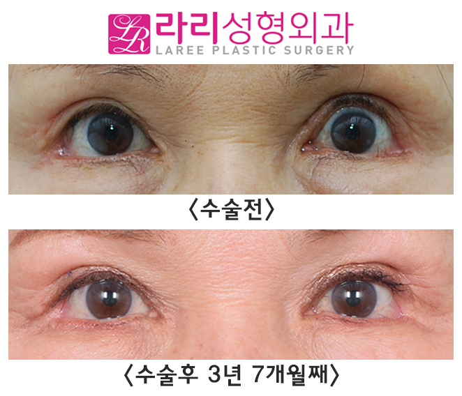 [Rari Plastic Surgery] Opening Your Eyes More Comfortably with Ptosis Correction image 2