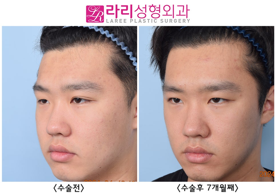 [라리성형외과] 쌍꺼풀 없애는 수술로 쌍꺼풀 없애기, 그 후 달라지는 얼굴 전체의 인상 관련 이미지 1