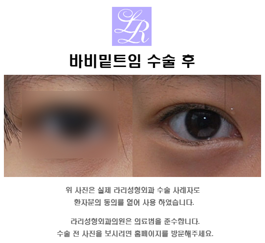 If You're Curious About Side Effects of Lower Eye Corner Surgery (feat. Conjunctival Edema) image 3