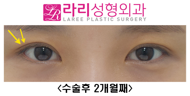 [Lari Plastic Surgery] Revision Double Eyelid Surgery to Correct Mucosal Exposure Caused by Sausage-Like Eyelids image 5
