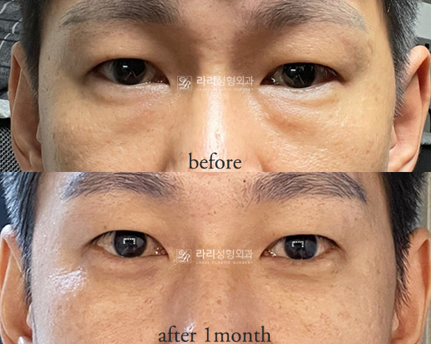 [Lari Plastic Surgery] For Bulging Under-Eyes That Eye Bag Creams / Eye Bag Patches Can’t Fix: Lower Eyelid Fat Repositioning! image 7