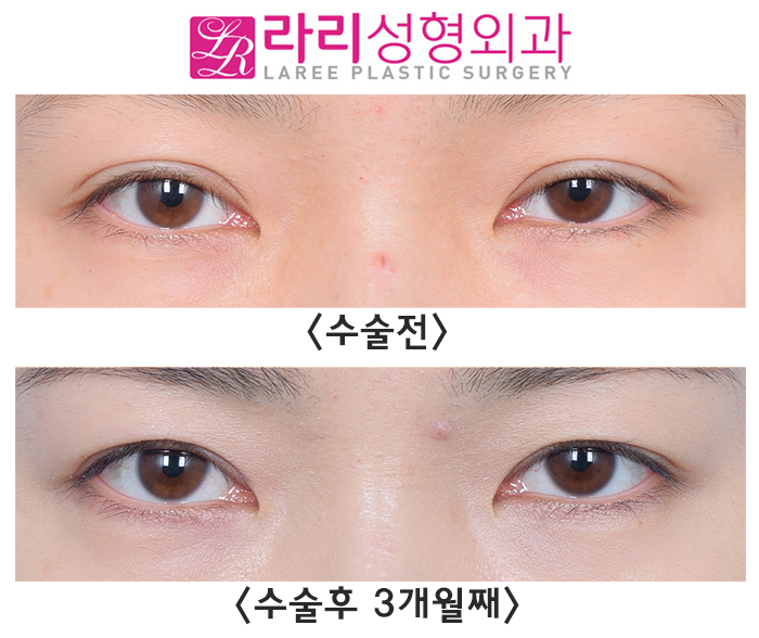 [라리성형외과] 쌍꺼풀재수술 라인낮추기 회복 기간 필수! 관련 이미지 1