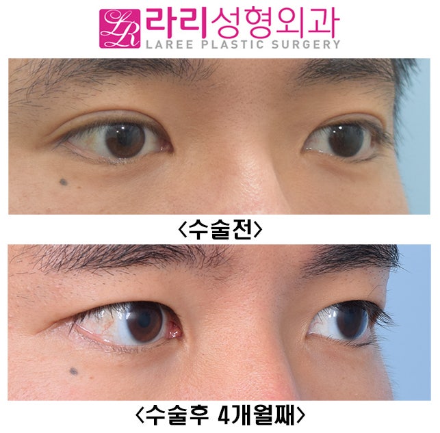 [라리성형외과] 성공적인 쌍꺼풀없애는수술 전후 사진과 효과 관련 이미지 2
