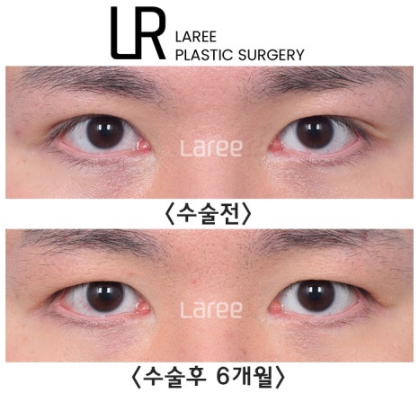 [라리성형외과] 쌍꺼풀없애는 무쌍 수술, 쌍꺼풀라인 낮추기가 아닙니다. (완전무쌍과 무쌍속쌍 그 차이) 관련 이미지 13