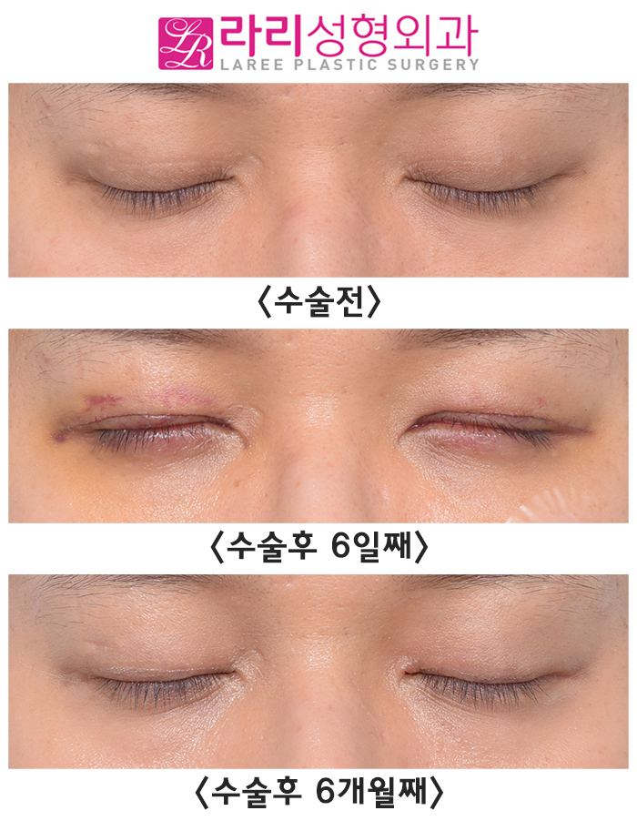 [라리성형외과] 쌍꺼풀없애기수술은 쌍꺼풀을 없애주는 겁니다. 관련 이미지 4
