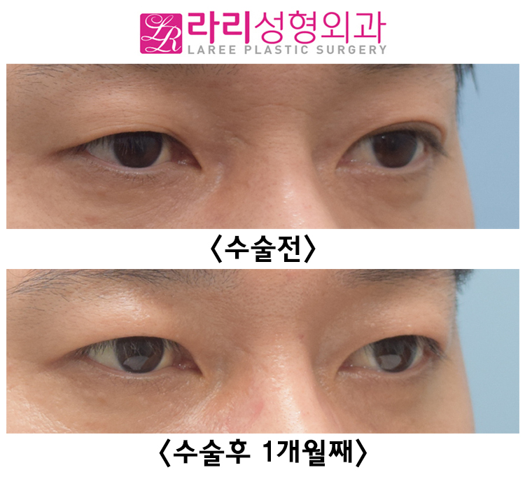 [라리성형외과] 쌍커풀 없애는 수술 후 회복이 빠른 경우 전후 사진 관련 이미지 5