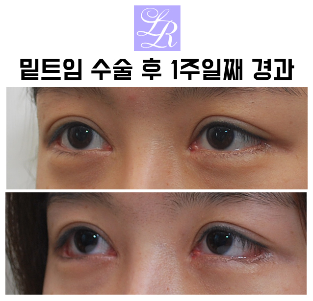 If You Want an S-Line Under Your Eyes, Try Lower Eye Widening image 10