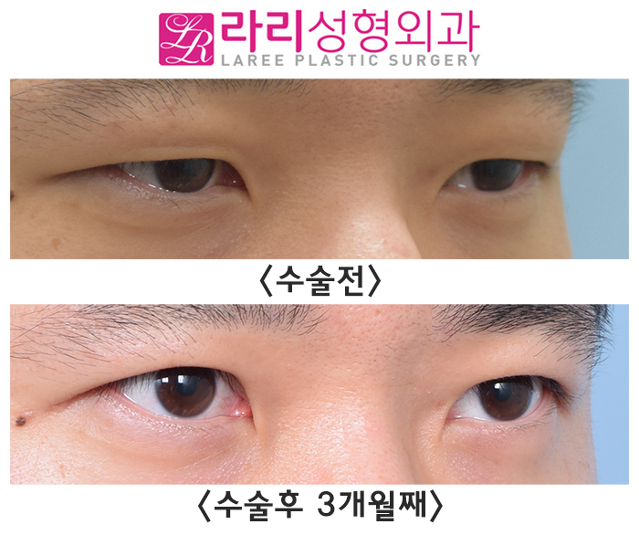 [Lari Plastic Surgery] Before and After Double-Incision Non-Incisional Eyelid Correction Surgery for Men That Makes the Eyes Exactly Twice as Big image 3