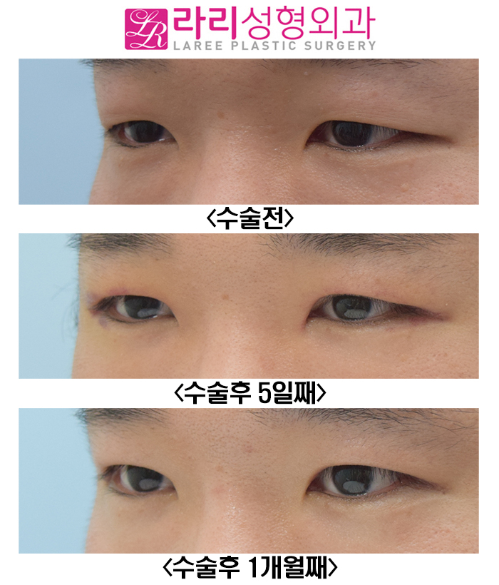 [Rari Plastic Surgery] Recovery Progress After Male Incisional Eye Opening Correction and Double-Eyelid-Free Eye Opening Correction Surgery: Natural and Neat image 5