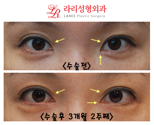 Before-and-After Photos of Epicanthoplasty / Canthoplasty image 1