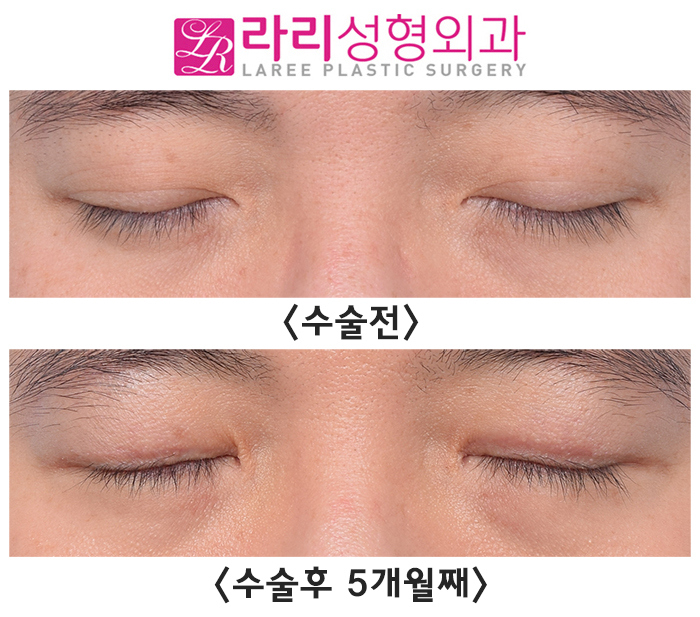 [라리성형외과] 쌍꺼풀없애기와 눈매교정수술의 콜라보 (+ 눈도 잘 감겨요) 관련 이미지 4
