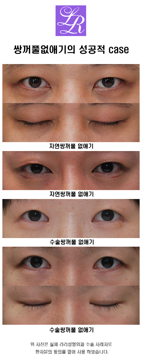 쌍꺼풀푸는수술이 쌍꺼풀없애는수술인가요? 관련 이미지 6