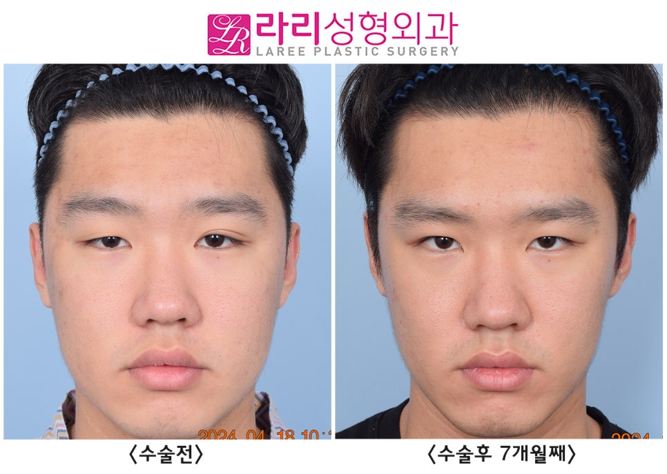 [라리성형외과] 쌍꺼풀 없애는 수술로 쌍꺼풀 없애기, 그 후 달라지는 얼굴 전체의 인상 관련 이미지 3