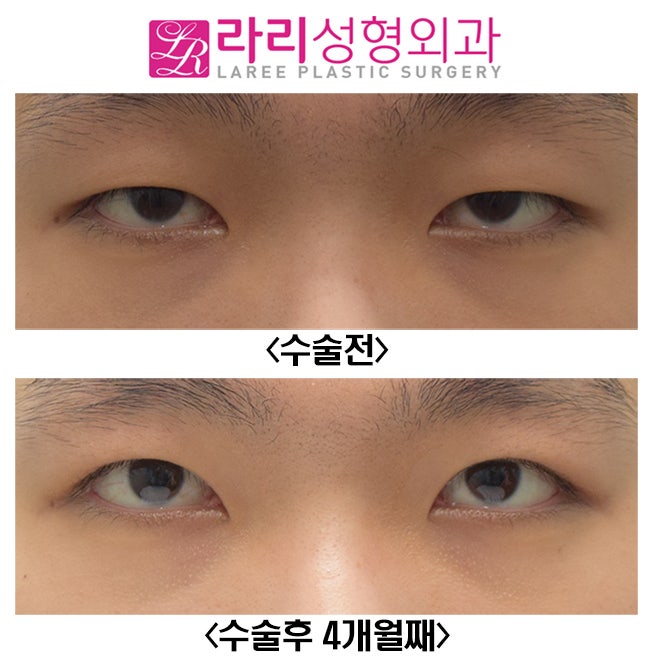 [Lari Plastic Surgery] Full Non-Incision Eye Correction, Effects and Before-and-After Photos (Different from Double Eyelid Surgery) image 5