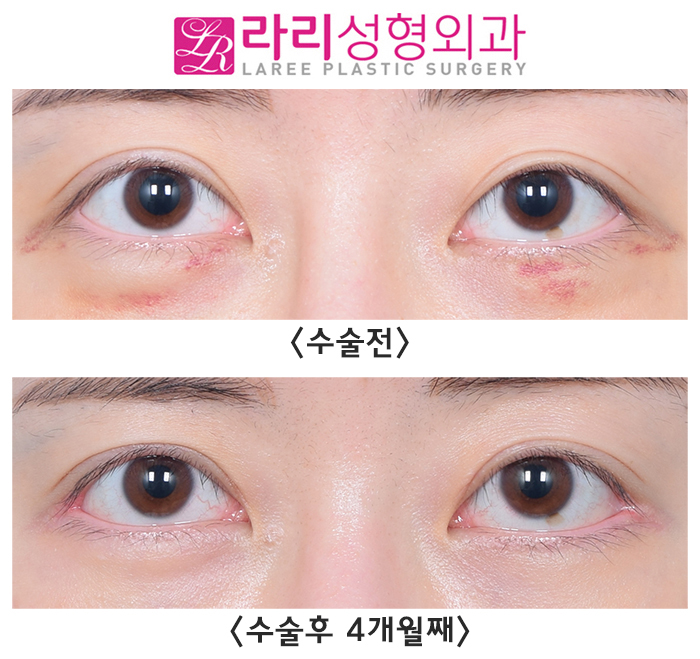 [Lari Plastic Surgery] Revision Double Eyelid Surgery: Micro Line Reduction, Micro Outer Corner Adjustment - Natural as if Nothing Was Done image 1