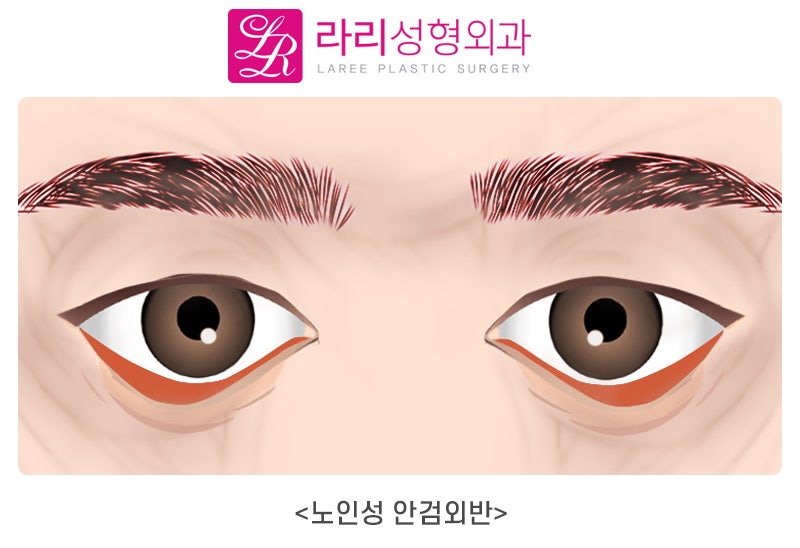 [Lari Plastic Surgery] What Is Ectropion? The Definition and Causes of Ectropion image 3