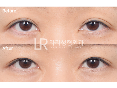 [라리성형외과] 흐릿한 눈, 소세지 쌍꺼풀 인라인 속쌍으로 깔끔하게 관련 이미지 6