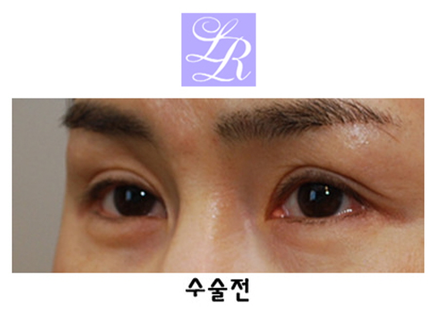 짝눈교정방법 중(쌍꺼풀재수술 + 눈매교정) 확인해야 될 사항 관련 이미지 2
