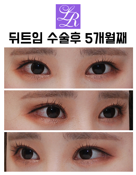듀얼트임? 뒷트임? 밑트임? 수술 효과 및 재발가능성 관련 이미지 3