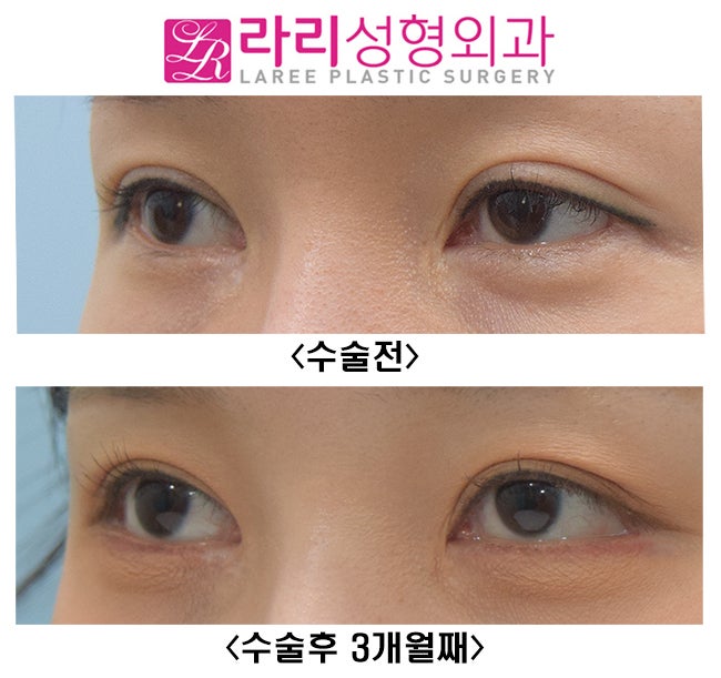 [Lari Plastic Surgery] If You Want to Be Sure of the Effect of Revision Lateral Canthoplasty, Do It Together with Revision Double Eyelid Surgery (Ptosis Correction Surgery). image 2