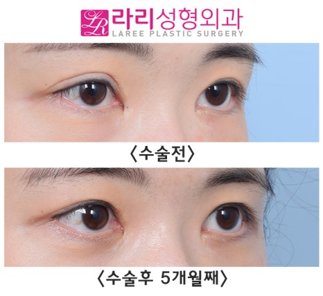 [Lari Plastic Surgery] Lowering the Double Eyelid Line to Near Single Eyelid Level: Before-and-After Photos of a Low Crease Revision image 2