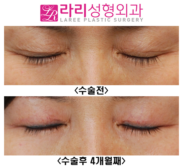 [라리성형외과] 앞쪽이 두껍고 불규칙한 쌍꺼풀라인 정리 수술 전후 관련 이미지 2