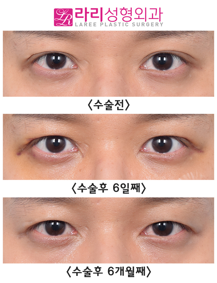 [라리성형외과] 쌍꺼풀없애기수술은 쌍꺼풀을 없애주는 겁니다. 관련 이미지 3