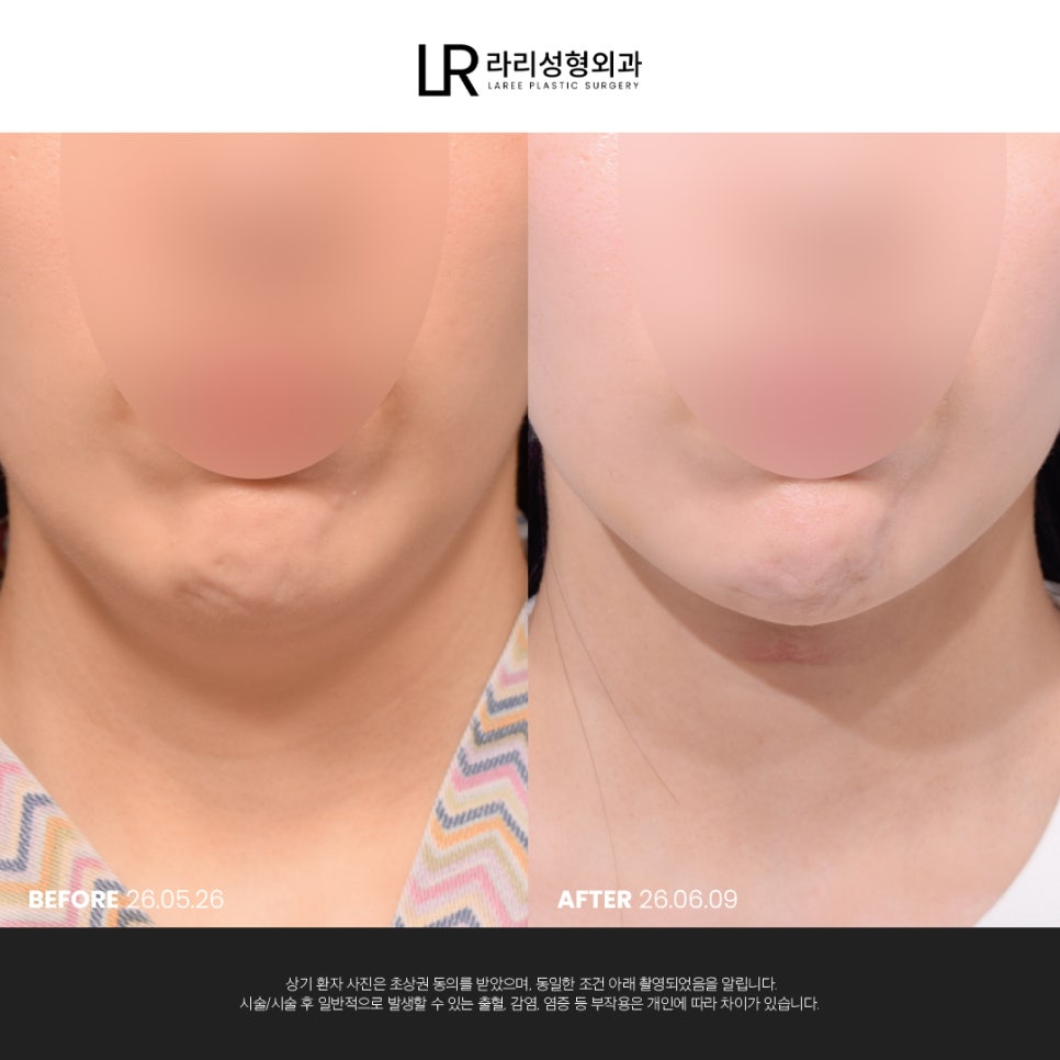 [라리성형외과] 이중턱 지방 흡입만으로는 아쉬운 얼굴 라인, 이중턱 근육 묶기도 같이 하면 효과가 두 배! 관련 이미지 4