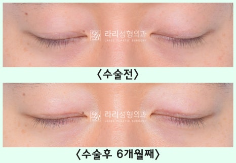 [Lari Plastic Surgery] Removing a Visible Double Eyelid (Double Eyelid Reversal Surgery), From Natural Double Eyelids to Surgical Double Eyelids: A to Z image 18