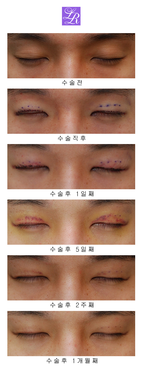 Are you curious about the recovery after double eyelid correction surgery for double eyelid side effects ...? image 2