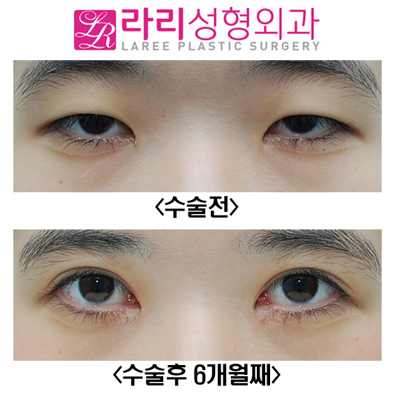 [Lari Plastic Surgery] Before-and-After Photos Showing Clear Results from Incisional Eye Correction and Epicanthoplasty image 1