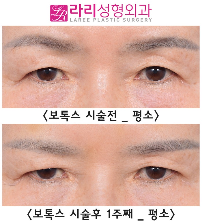 [Rari Plastic Surgery] Why You Should Get Forehead Botox Before Upper Blepharoplasty, as Seen in Before-and-After Photos image 1