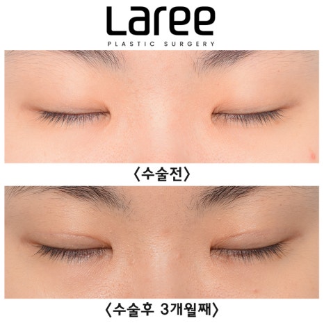 [Lari Plastic Surgery] A Collection of Various Surgeries for Double Eyelids image 2
