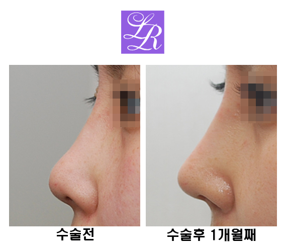 코재수술 코끝을 오똑하게 관련 이미지 4